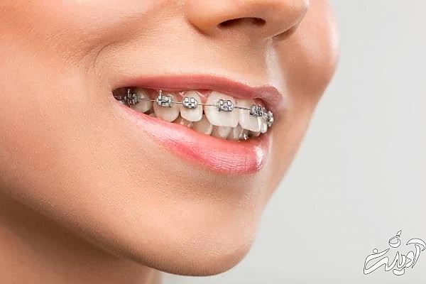 آسیب های ارتودنسی